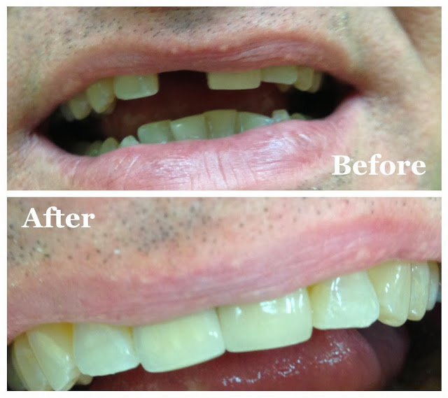 Single tooth Implant, Dentist Brampton, Brampton Dental Office, Tooth Replacement, Best Dentist in Brampton, Family Dentist in Brampton,