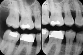 Dental x-rays Dentist Brampton, Dental x-Rays,