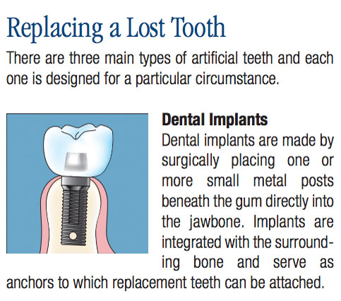 Common Dental Procedures, Replacing a Lost Tooth, Brampton Dentists, To Dentists in Brampton, Dental Facts, Dental Information,