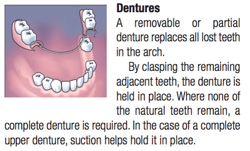 Common Dental Procedures, Replacing a Lost Tooth, Brampton Dentists, To Dentists in Brampton, Dental Facts, Dental Information,