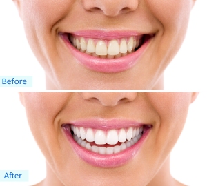 Brampton Dentists, Teeth Whitening, Top Dentist in Brampton, Dental Care, Dental info, Best Dentist in Brampton, 