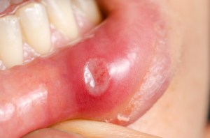 Canker Sores canker sores, brampton dentists, what causes canker sores, top dentists in brampton, mouth sores,
