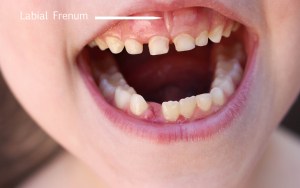 Labial Frenum, Dental Procedures, Top Dentist in Brampton, Brampton Kids Dentists, Gum Disease, Gum Specialists,